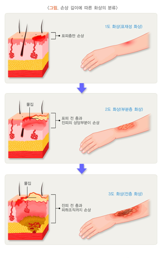 2도화상 회복기간과 빠르게 회복한 방법
