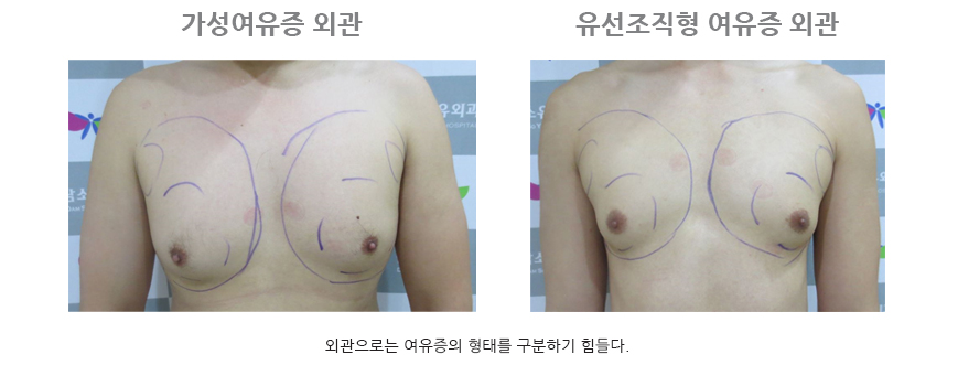 여유증 살 빼고 변화