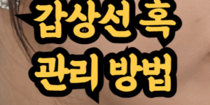 갑상선 혹 줄이는 방법